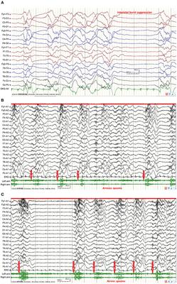 Status Epilepticus Manifested as Continuous Epileptic Spasms